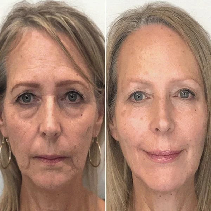 🔥2026, Exclusive premium COMPLEX technology and sophisticated design 2-minute wrinkle-reducing serum( ✅ Permanently removes wrinkles in 3 minutes ✅ )