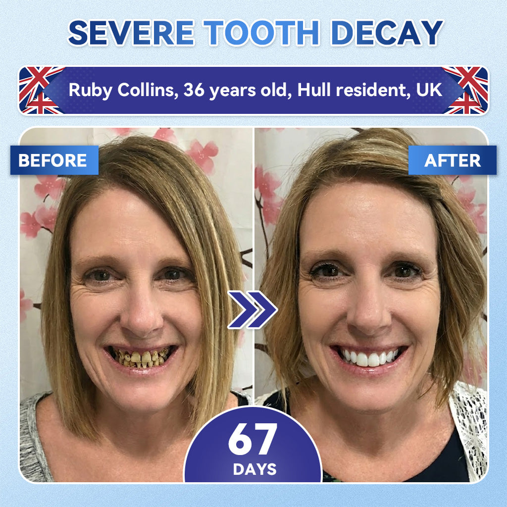 🦷 Tideglusib Fast‑Dissolving Tooth & Gum Repair Oral Strips 💥🎉 (Supports tooth repair and helps relieve gum discomfort and other common oral concerns)