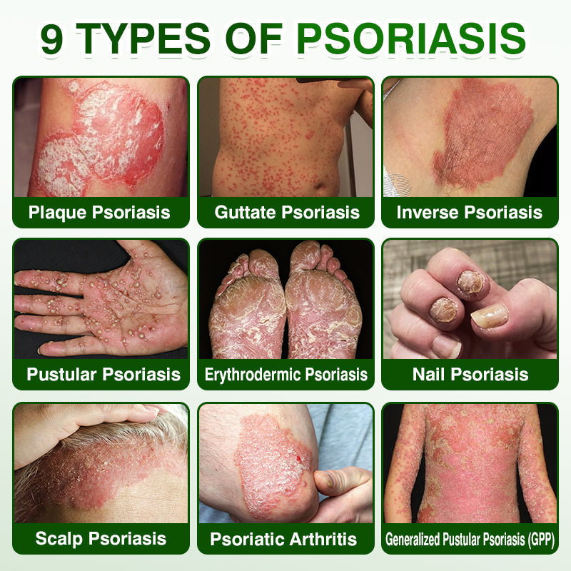 🇺🇸🏆👨‍⚕️✅SkinRecovery Reishi Psoriasis Repair Spray