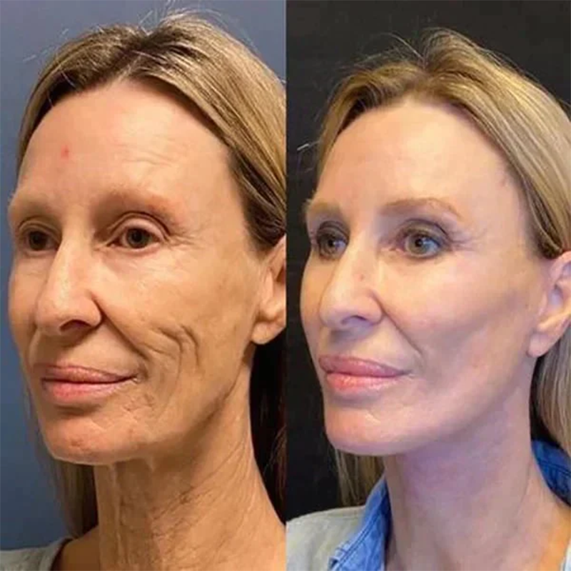 🔥2026, Exclusive premium COMPLEX technology and sophisticated design 2-minute wrinkle-reducing serum( ✅ Permanently removes wrinkles in 3 minutes ✅ )