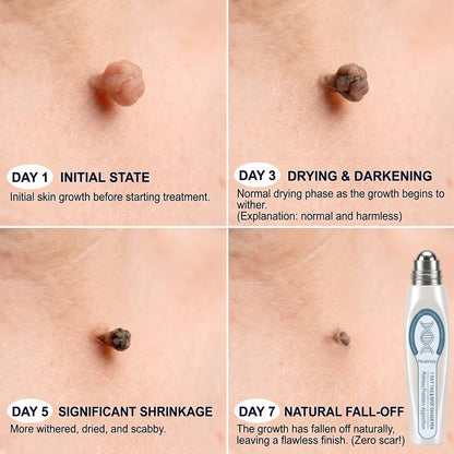 🖊 Advanced Wart & Skin Tag Removal Pen
